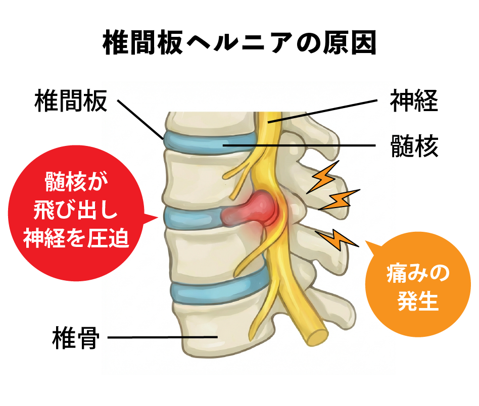 椎間板ヘルニアの原因