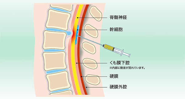 脊髄腔内ダイレクト注射療法