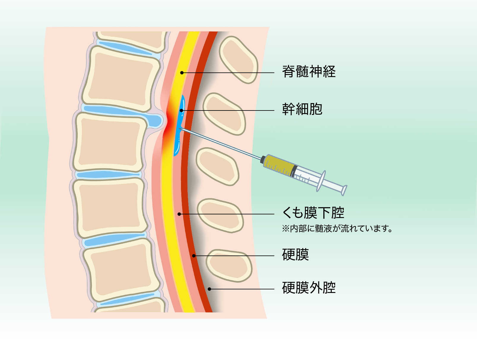 脊髄腔内への幹細胞ダイレクト注射のイメージ図