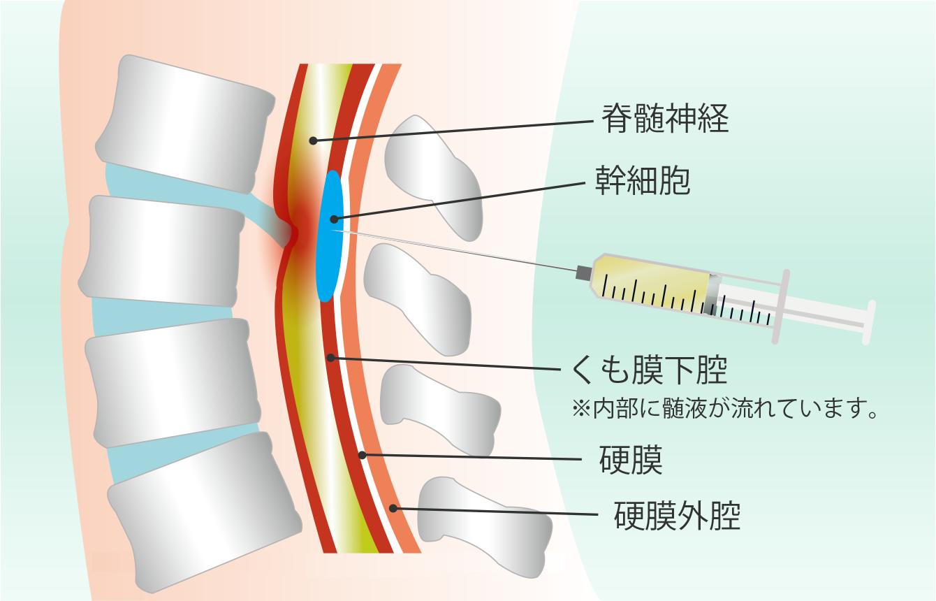 脊髄内への直接投与する幹細胞療法