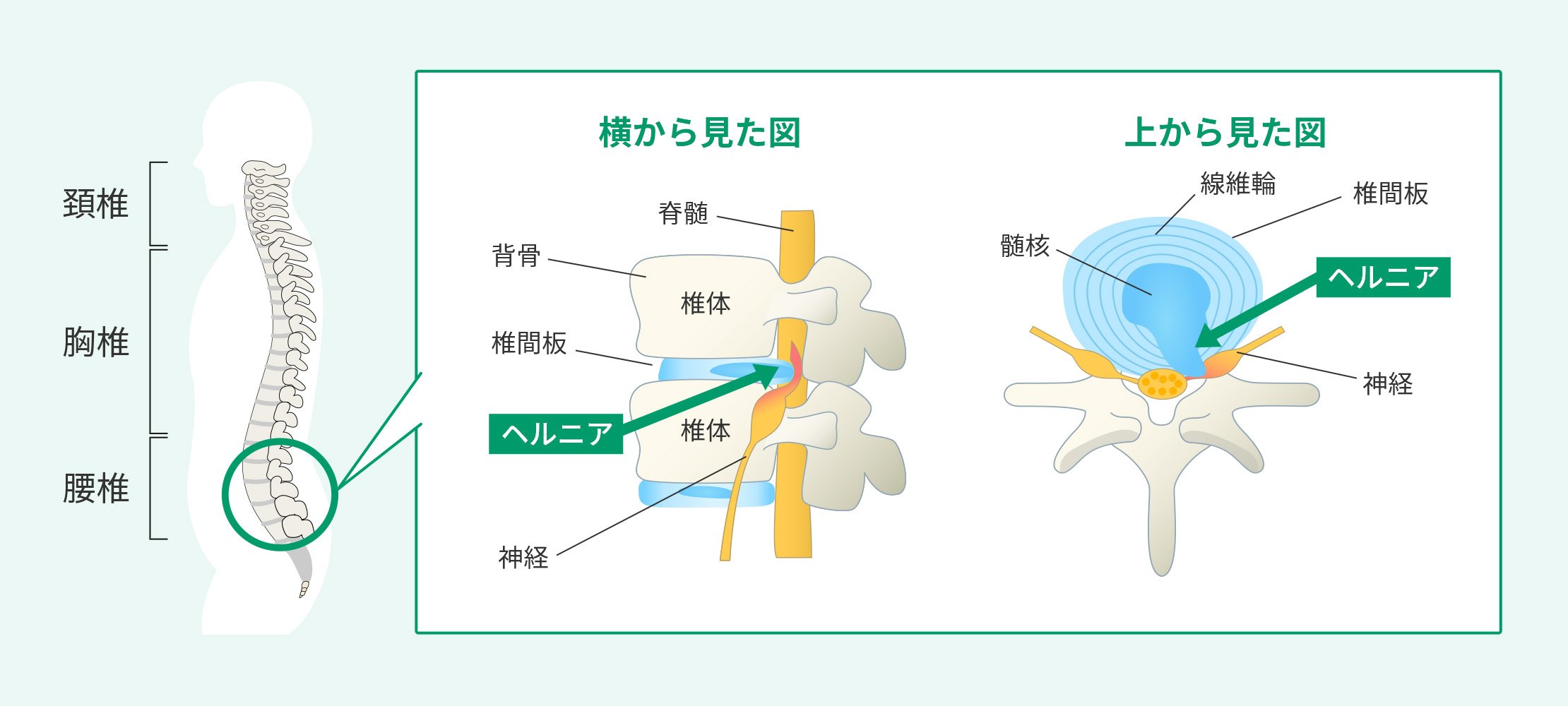 椎間板ヘルニアとは