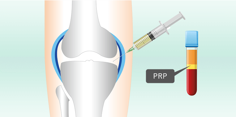 膝へのPRP療法