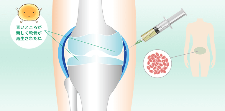 変形性膝関節症の幹細胞治療
