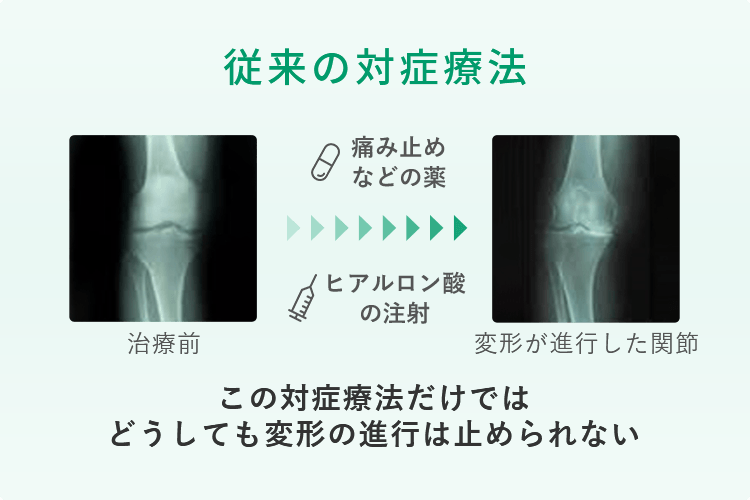 膝関節のレントゲン、治療前、治療後