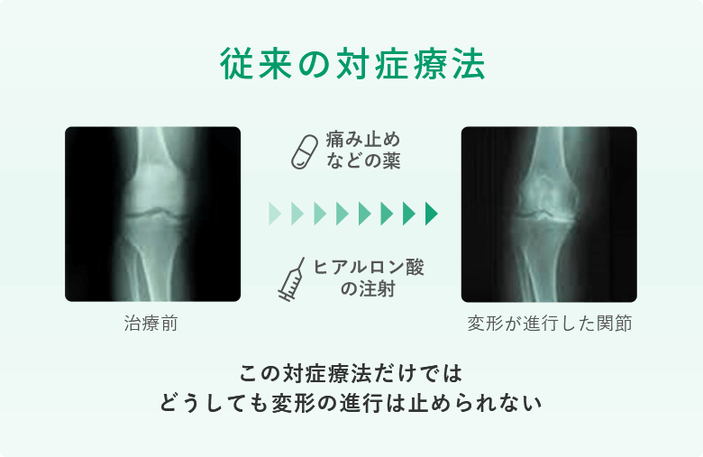 変形性膝関節症の進行は対症療法（痛止薬やヒアルロン酸注射）では止まらない