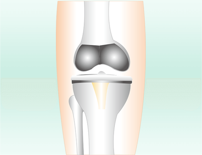 膝の人工関節置換術