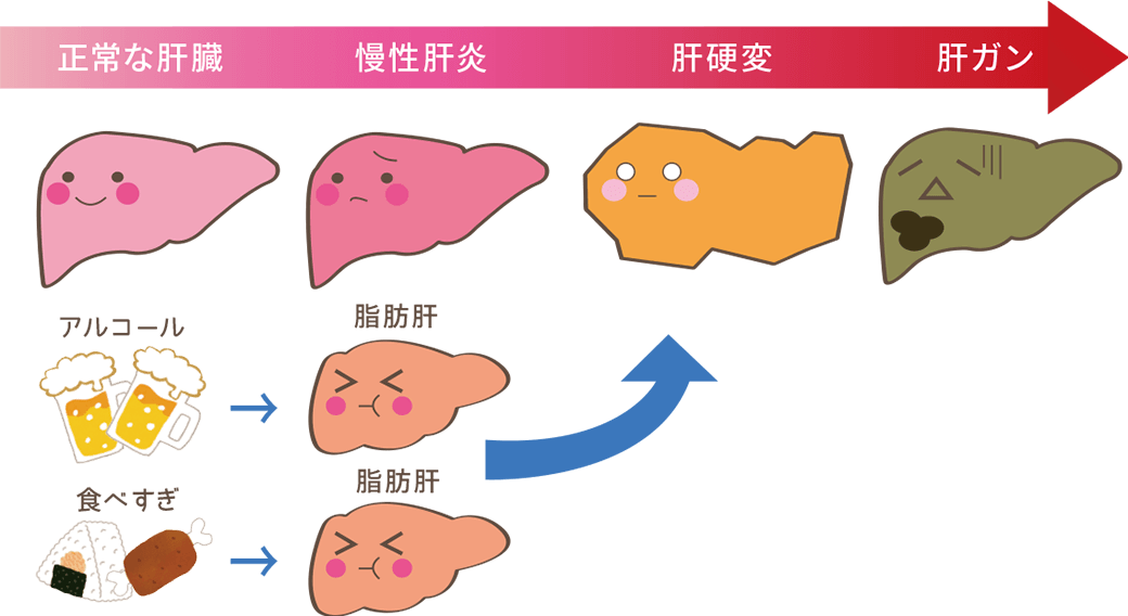 正常な肝臓→慢性肝炎→肝硬変→肝ガン