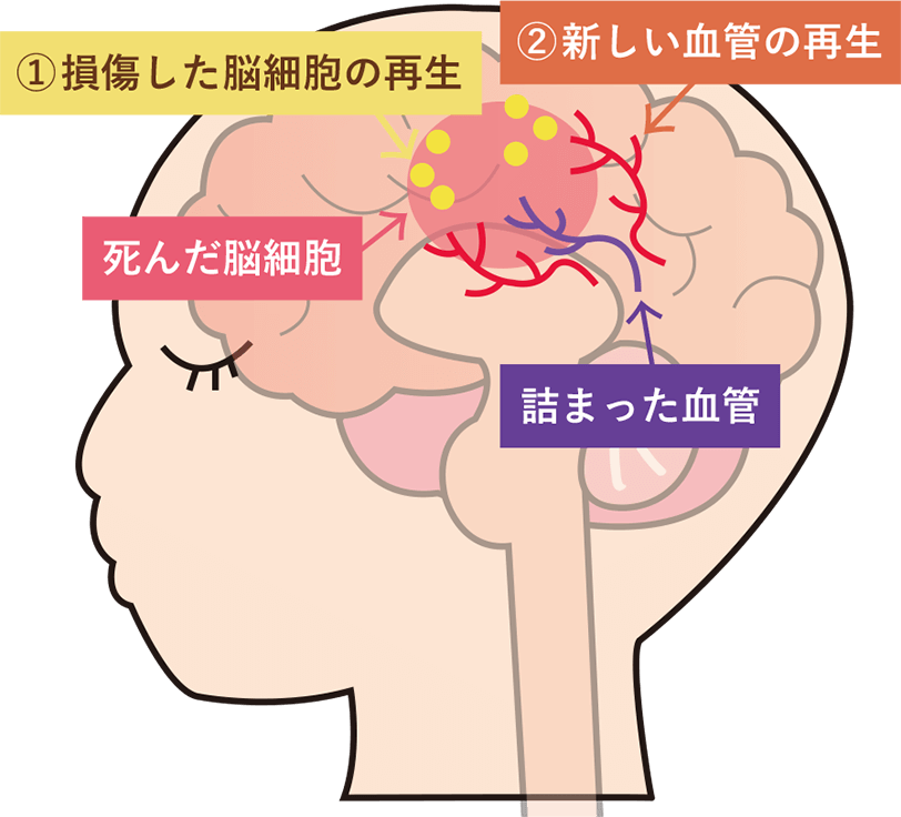 脳卒中（脳梗塞・脳出血）の概念図