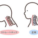 ストレートネック